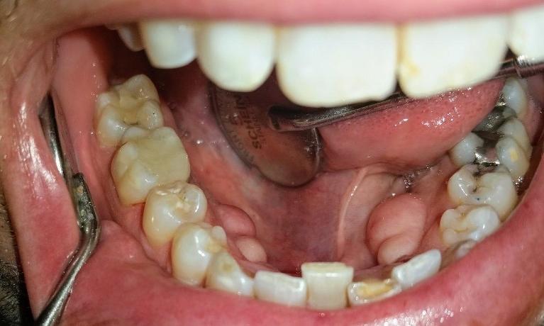 Patient with tooth-colored fillings Mesquite, TX