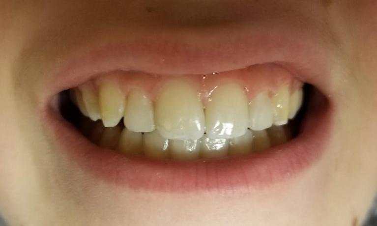 Patient with Peg shaped laterals in Mesquite, TX