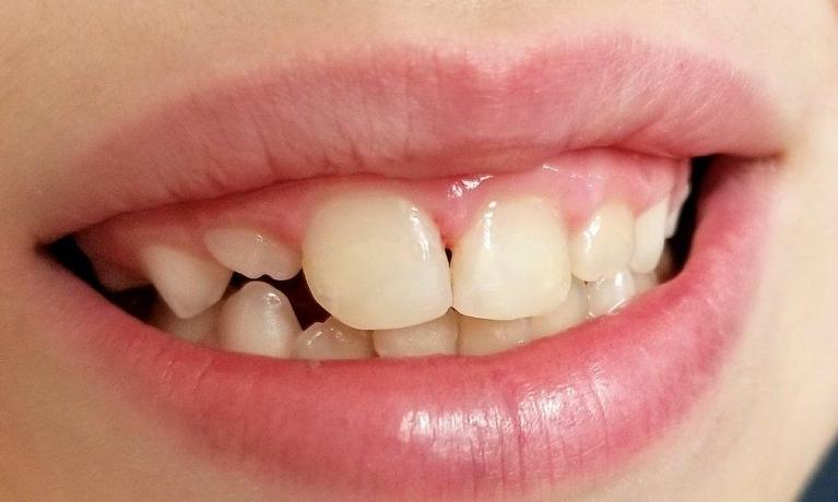 Procedure-for-a-Nine-Year-Old-in-Mesquite-TX-After-Image