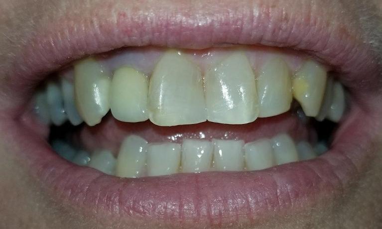 Same-Day-Treatment-in-Mesquite-TX-After-Image