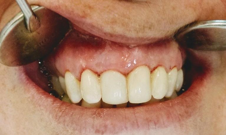 Patient with Composite Bonding | Mesquite, TX