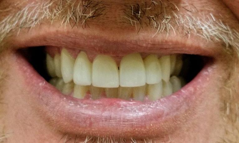 Porcelain-Veneers-Corrected-Multiple-Issues-in-Mesquite-TX-After-Image