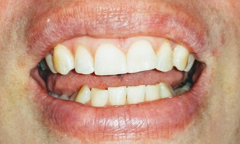 Patient after composite bonding in Rockwall, TX