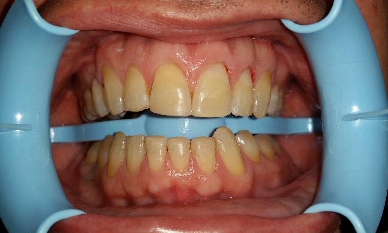 Enamel-loss-at-the-Gum-Line-in-Mesquite-TX-After-Image
