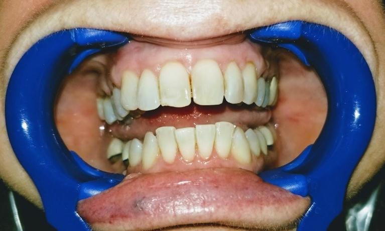 Wow-What-a-Difference-After-Image