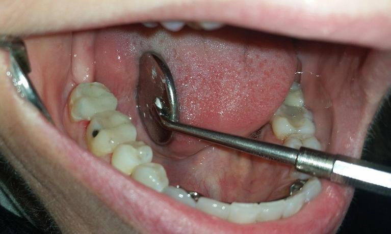 Patient after porcelain onlays in Mesquite, TX