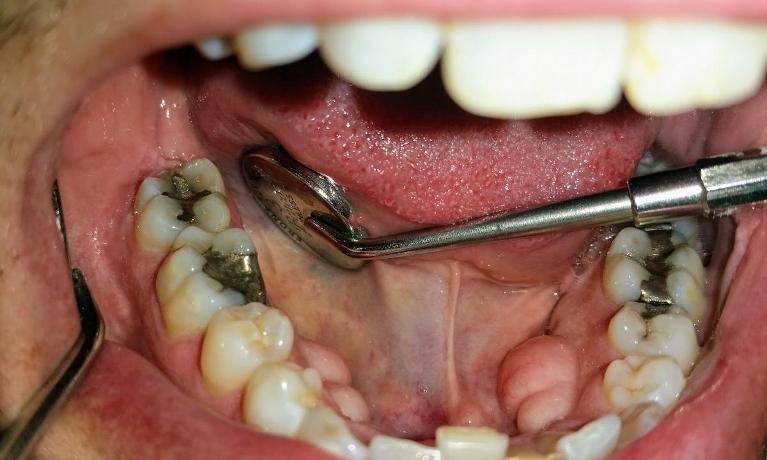 Patient before Porcelain Fillings | Mesquite, TX