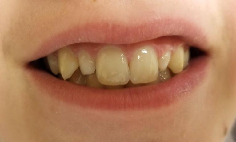 Patient before composites in Mesquite, TX