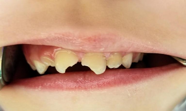 Procedure-for-a-Nine-Year-Old-in-Mesquite-TX-Before-Image