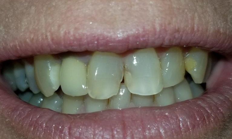 Same-Day-Treatment-in-Mesquite-TX-Before-Image