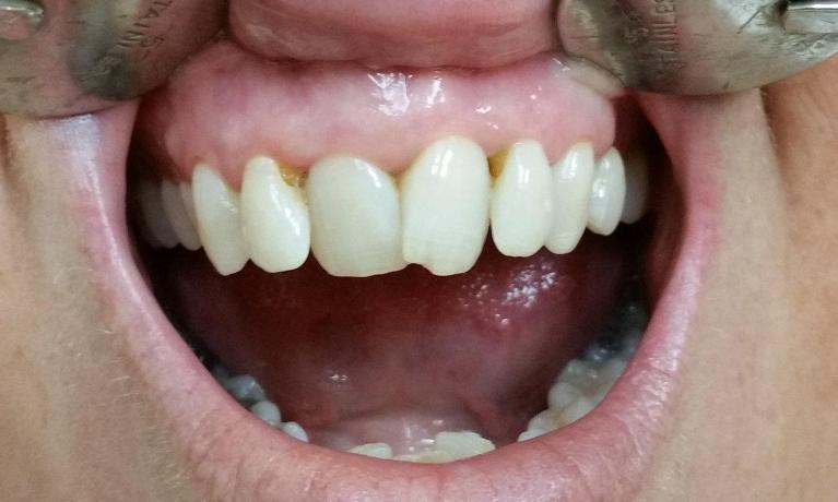 Patient before composite bonding Mesquite, TX