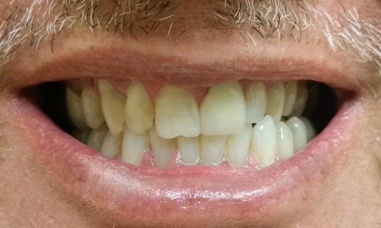 Porcelain-Veneers-Corrected-Multiple-Issues-in-Mesquite-TX-Before-Image