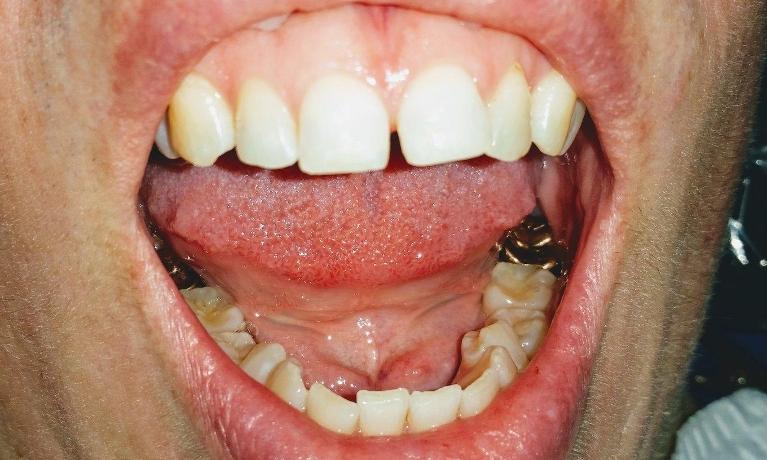 Patient before composite bonding | Rockwall, TX