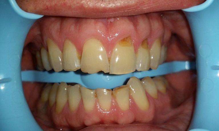 Enamel-loss-at-the-Gum-Line-in-Mesquite-TX-Before-Image