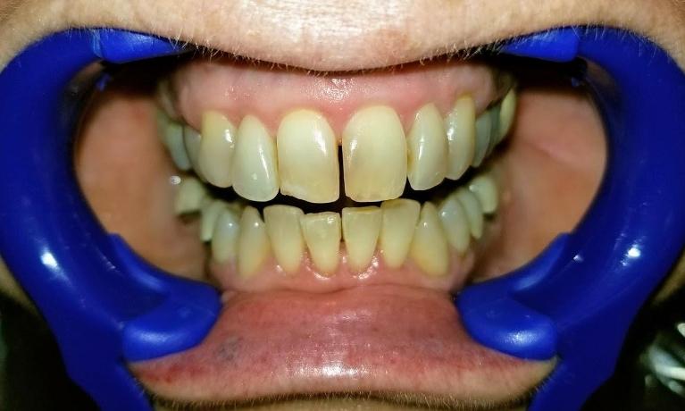 Wow-What-a-Difference-Before-Image